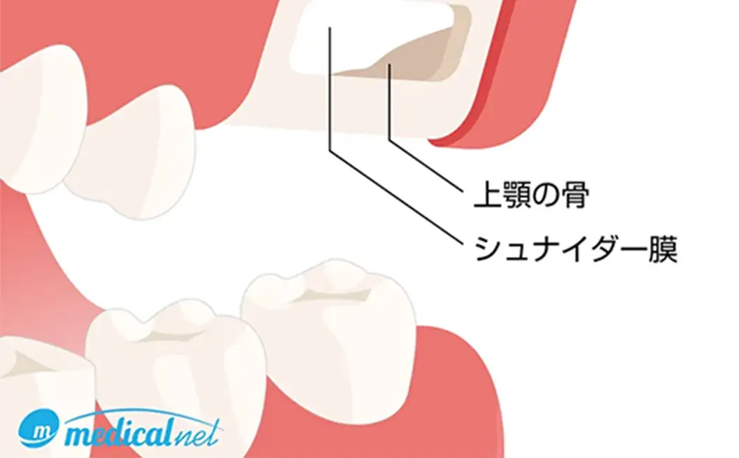 サイナスリフト
