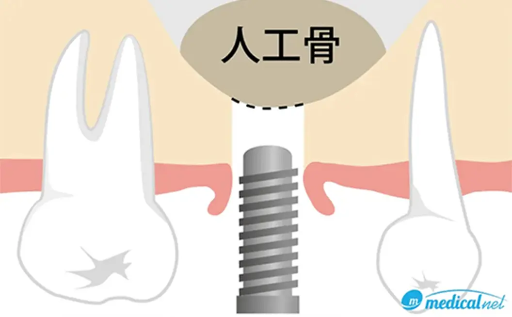 ソケットリフト